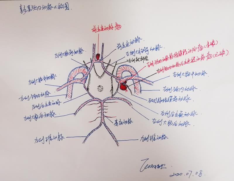患者顱內動脈示意圖,。張曉泉 繪