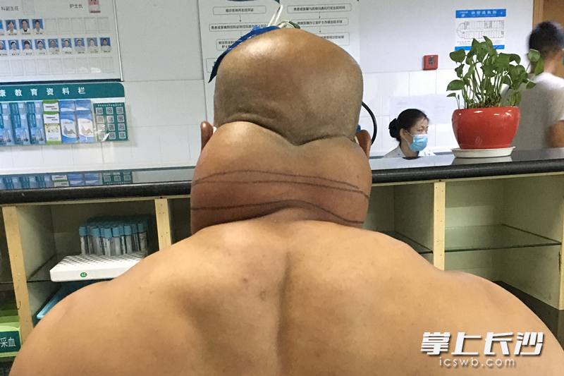 手術(shù)前的張先生,。