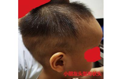 手術(shù)前,，豆豆頭型如橄欖球。
