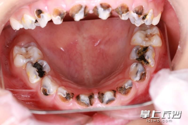 3歲孩子20顆乳牙全被蛀壞,。