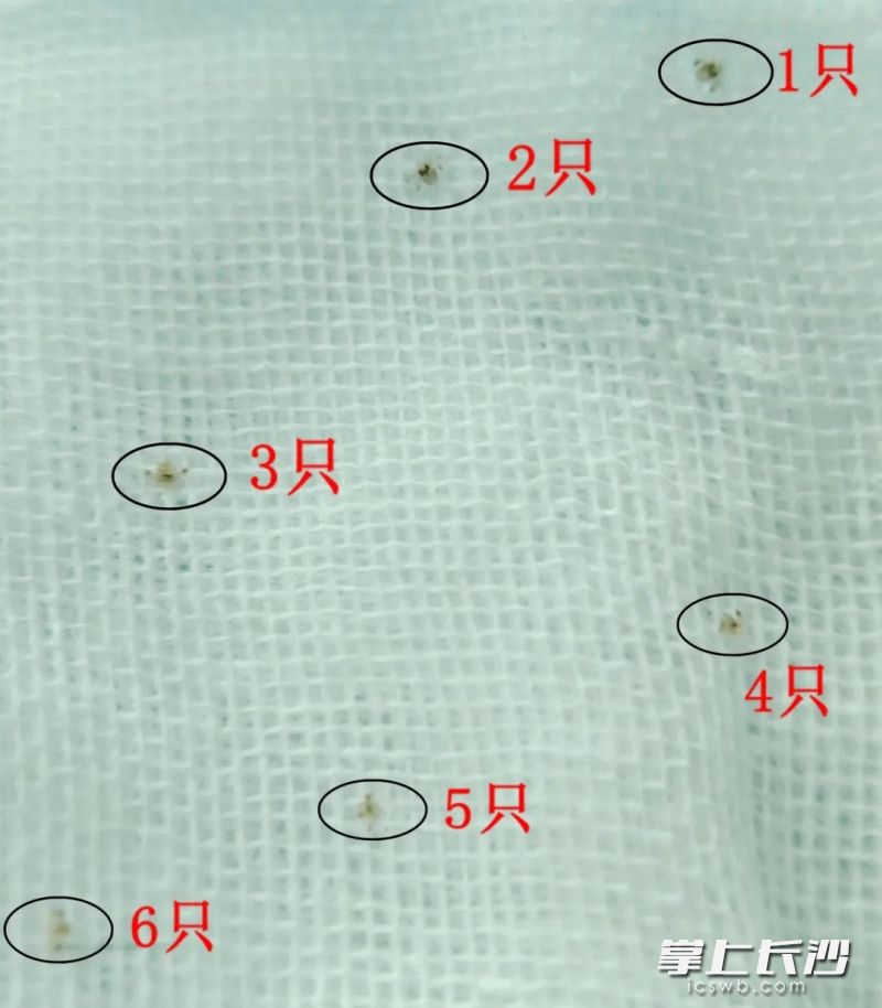 醫(yī)生從西西的眼里取出6只虱子,。   長(zhǎng)沙晚報(bào)通訊員 覃娟 攝