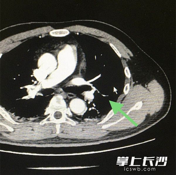 從患者的肺血管造影檢查可示,，左肺下葉肺動脈分支可見線性充盈缺損，提示肺栓塞,。