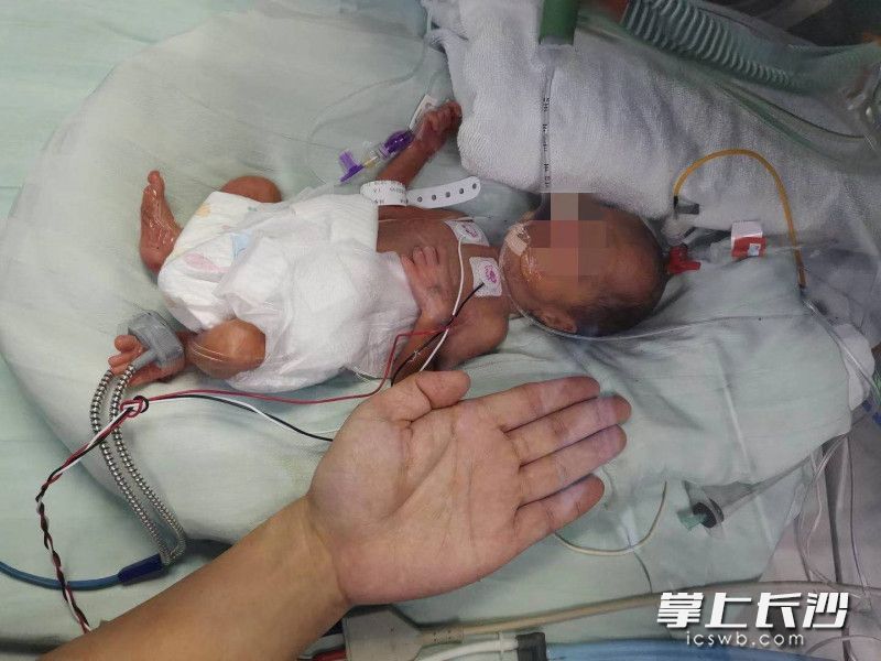 剛出生的睿睿,，比成人的巴掌大不了多少。  均為醫(yī)院供圖