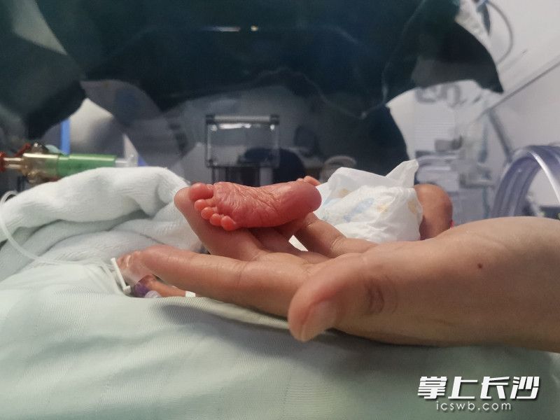 早產(chǎn)的睿睿剛出生時小得可憐,。