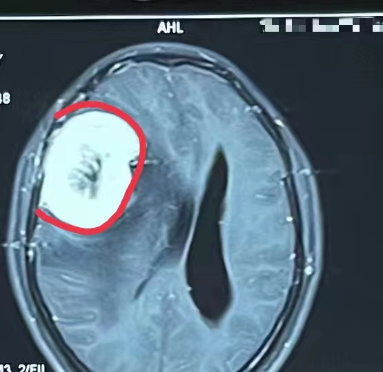 患者術前影像顯示：腦膜瘤供血豐富,。長沙晚報通訊員 梁輝 肖潔 供圖